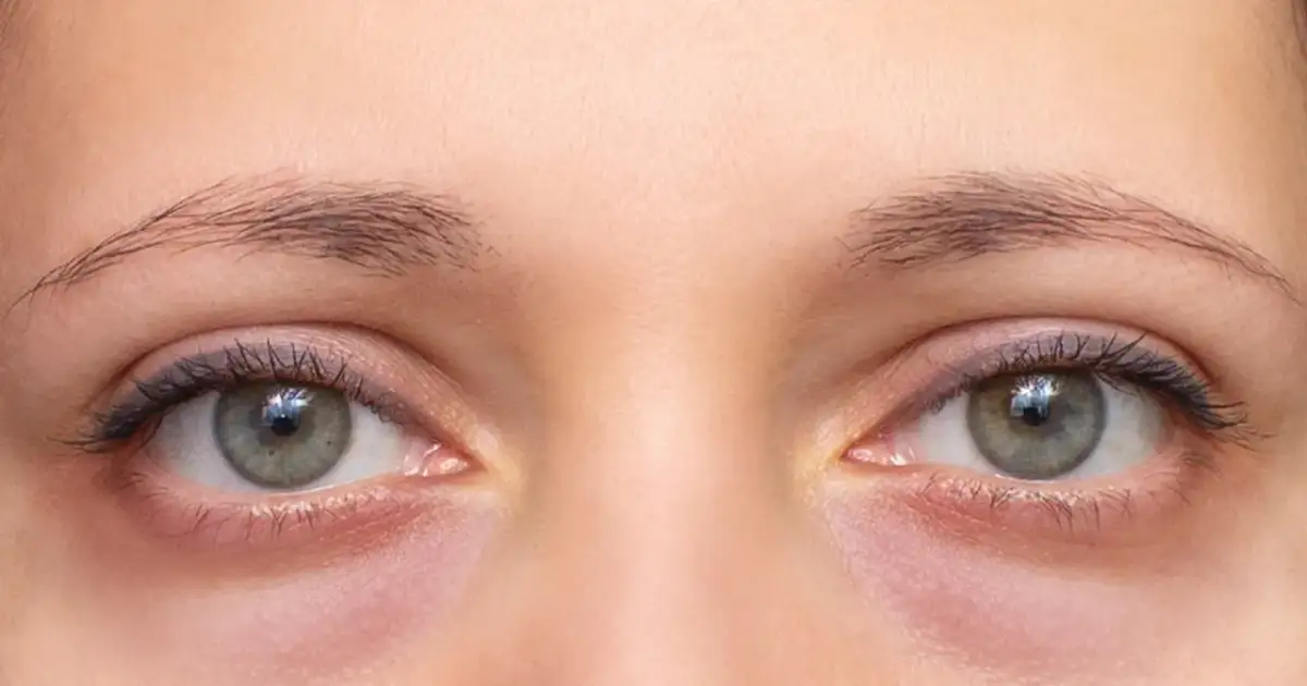 Worki pod oczami: Czy to tylko zmęczenie? Kiedy do lekarza?