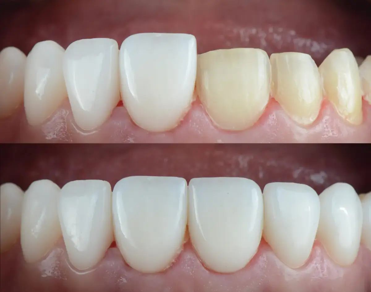 Ile licówek na zęby? Zaplanuj idealną metamorfozę uśmiechu