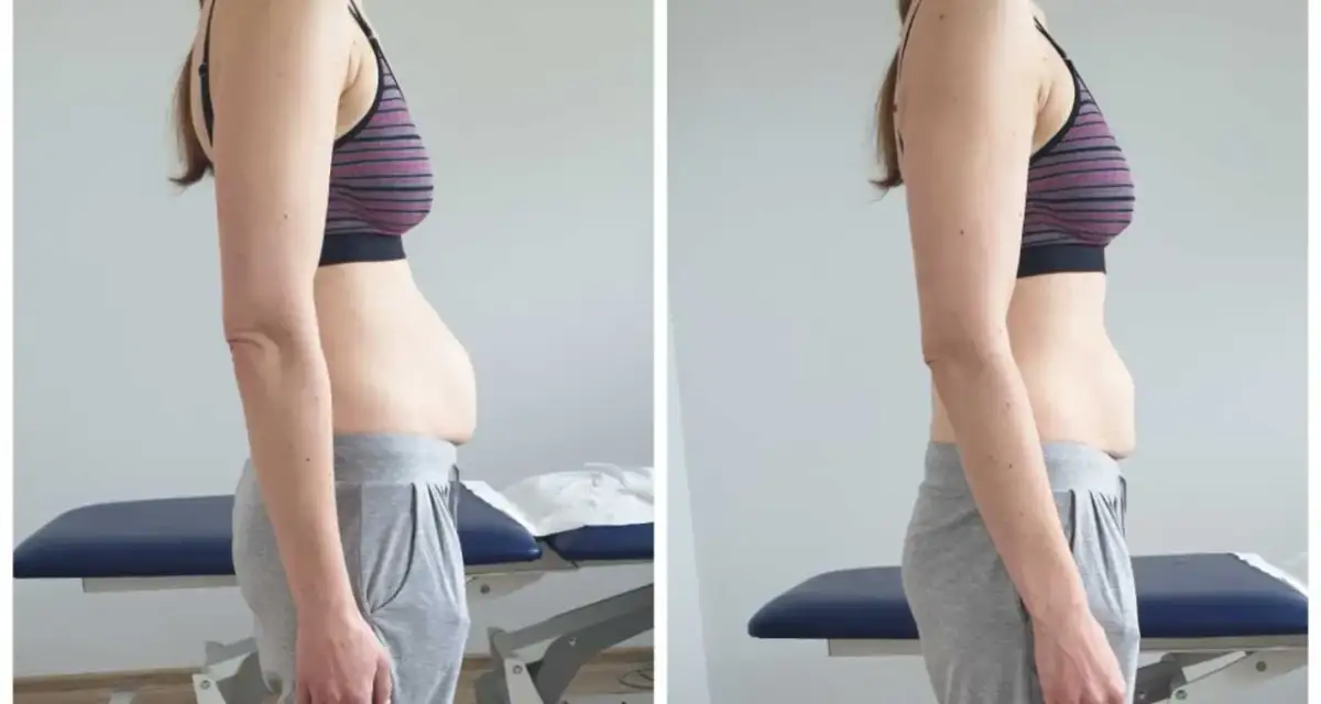 Porównanie brzucha przed i po ćwiczeniach. Jak sprawdzić rozejście mięśnia prostego brzucha?