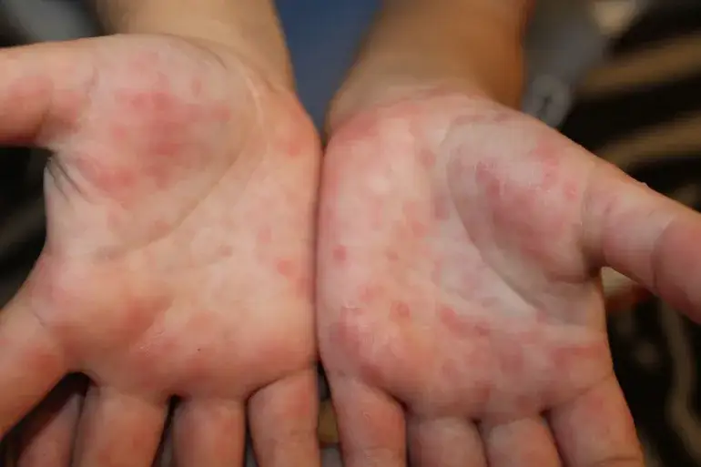 Jakie leki na bostonkę pomogą złagodzić objawy u dzieci?