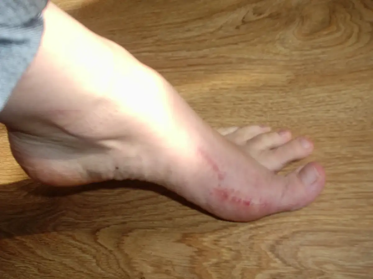 Stopa z widocznym zaczerwienieniem i śladami po urazie w okolicy palucha na drewnianym tle.