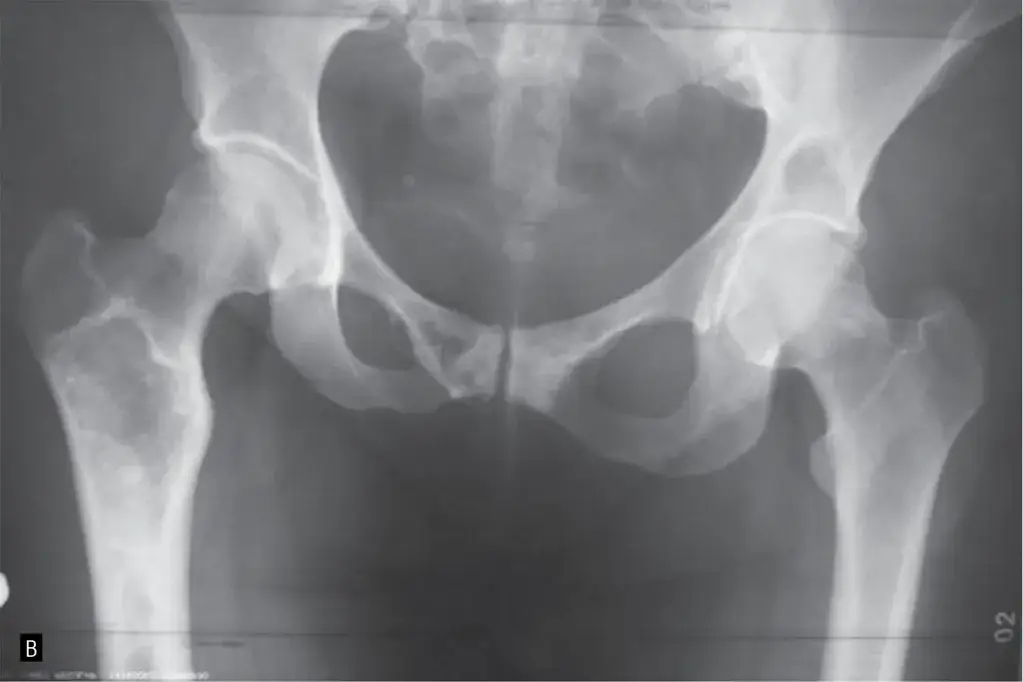 Czym jest ognisko osteolityczne? Przyczyny, objawy i diagnostyka zmian w kościach