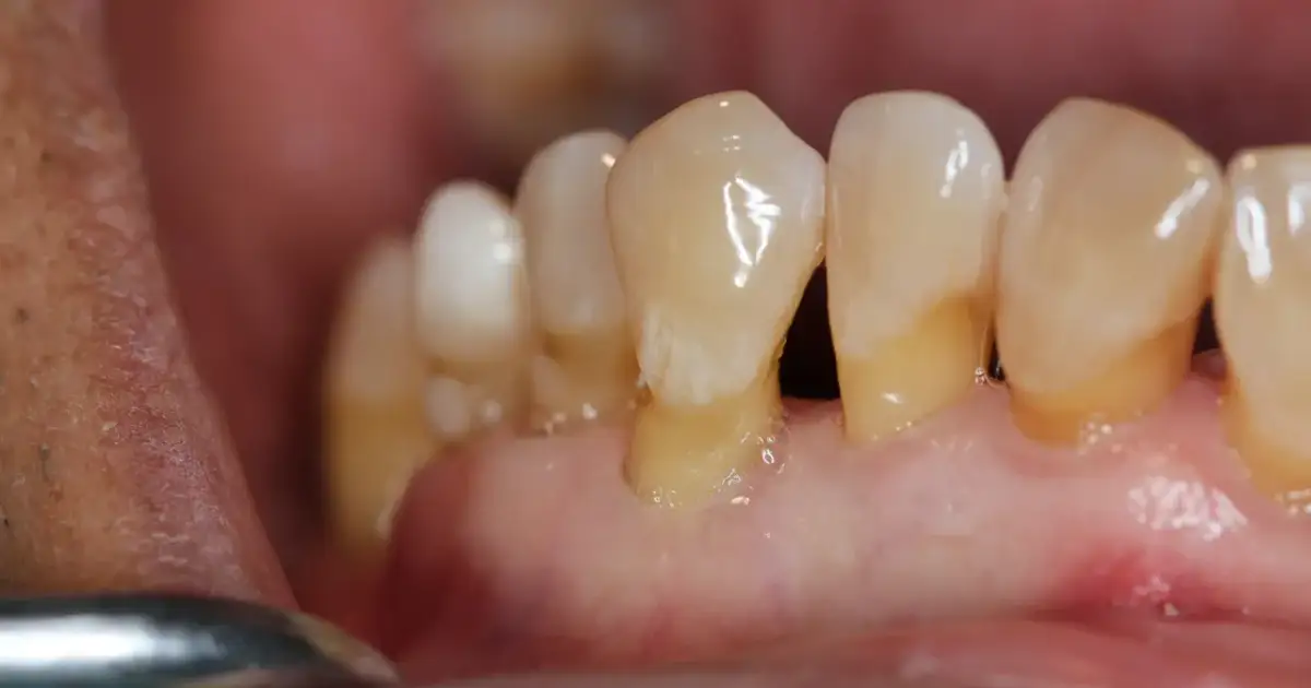 Dlaczego dziąsła się cofają? Poznaj przyczyny i skutki recesji