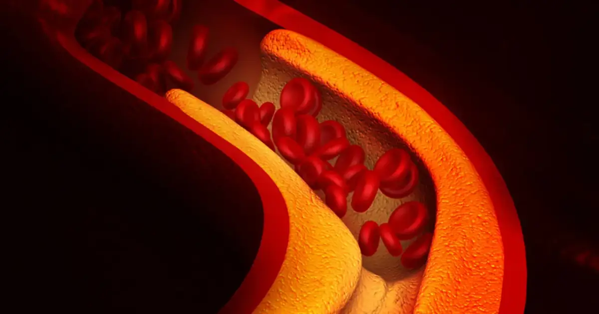 Cholesterol 200 czy to dużo? Sprawdź, co to oznacza dla zdrowia