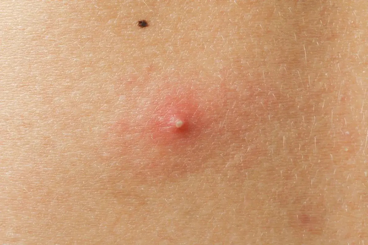 Jak pozbyć się pryszczy na plecach? Sprawdzone metody i porady