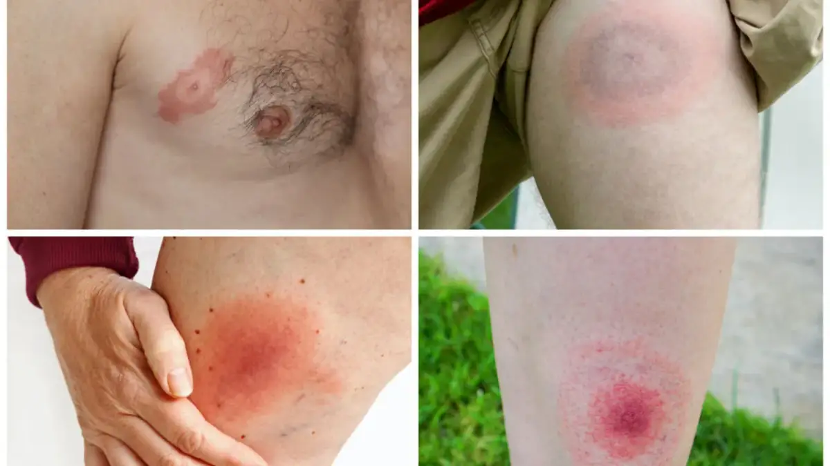 Neuroborelioza objawy psychiczne: Jak rozpoznać i leczyć skutki