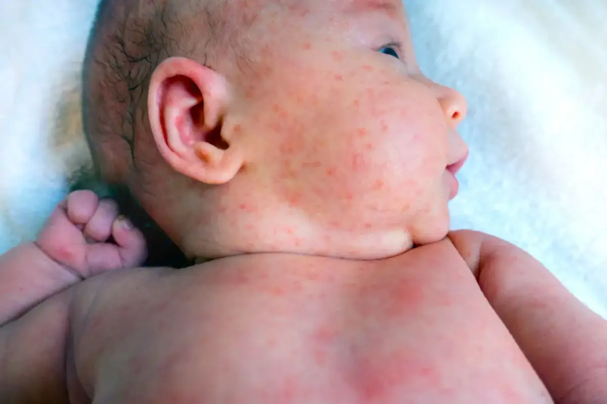 Potówki na twarzy niemowlaka: Szybka ulga i skuteczne zapobieganie