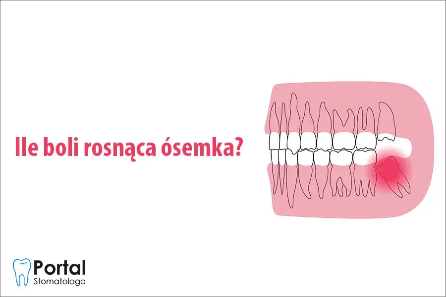 Ósemki: Kiedy rosną? Objawy, ból i kiedy iść do dentysty