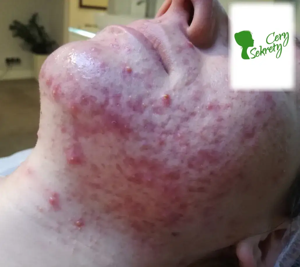 Profilaktyka trądziku: Odkryj sekrety czystej cery pielęgnacja, dieta