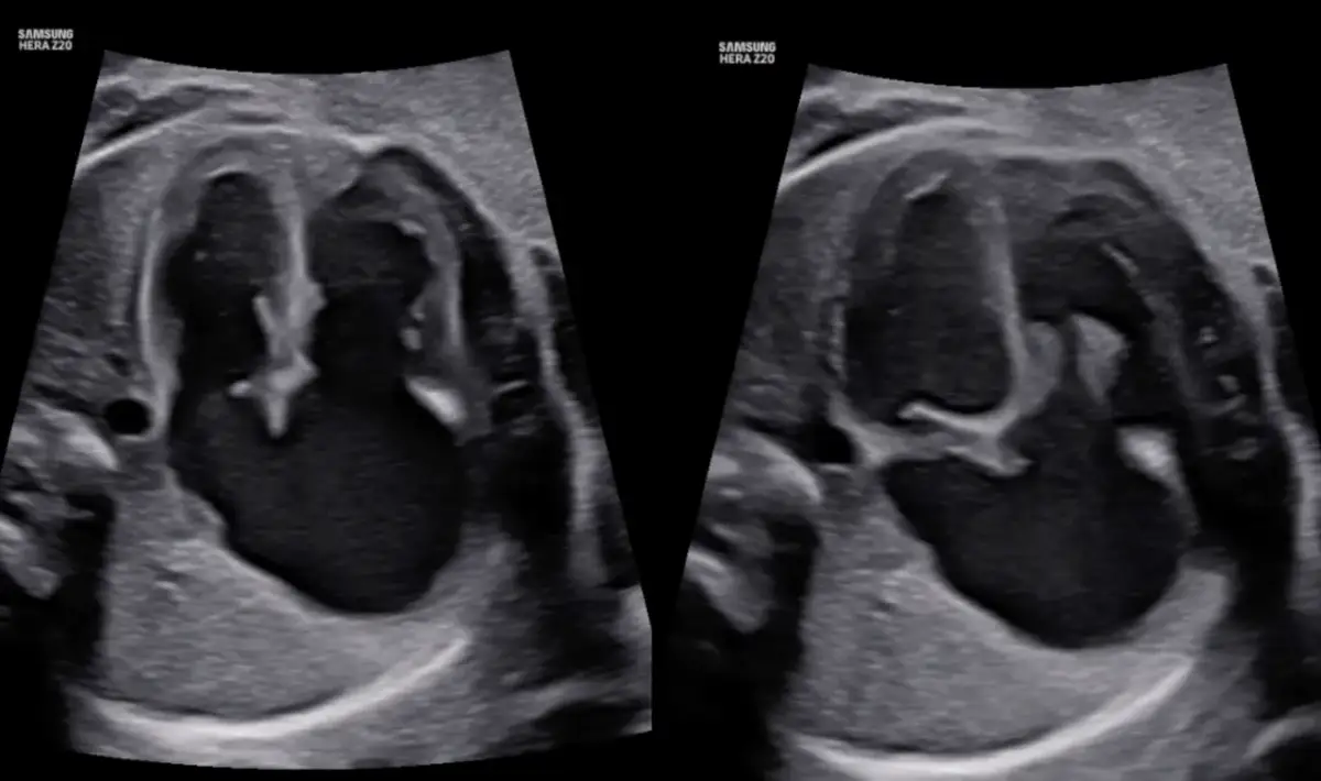 RTG w ciąży: Prześwietlenie płuc bezpieczne dla płodu? Poznaj fakty