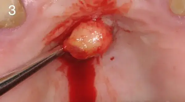 Objawy włókniaka jamy ustnej – jak rozpoznać i czy to groźne?