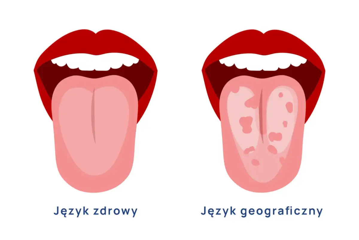 Dwa języki: zdrowy, różowy i gładki, oraz język geograficzny z plamami.