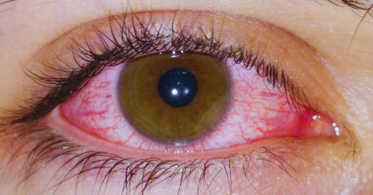 Czerwone oczy po marihuanie: Dlaczego i jak szybko się ich pozbyć?