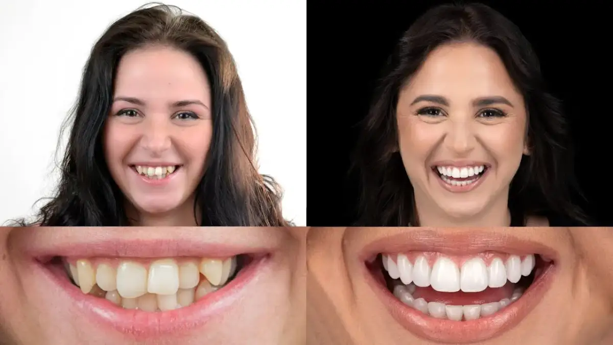 Aparat na zęby zmienia twarz? Sprawdź, jak!