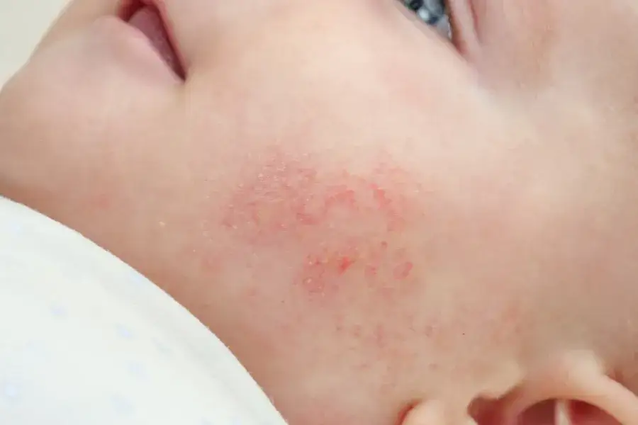 Rozpoznaj skazę białkową u niemowląt: kluczowe objawy i co robić