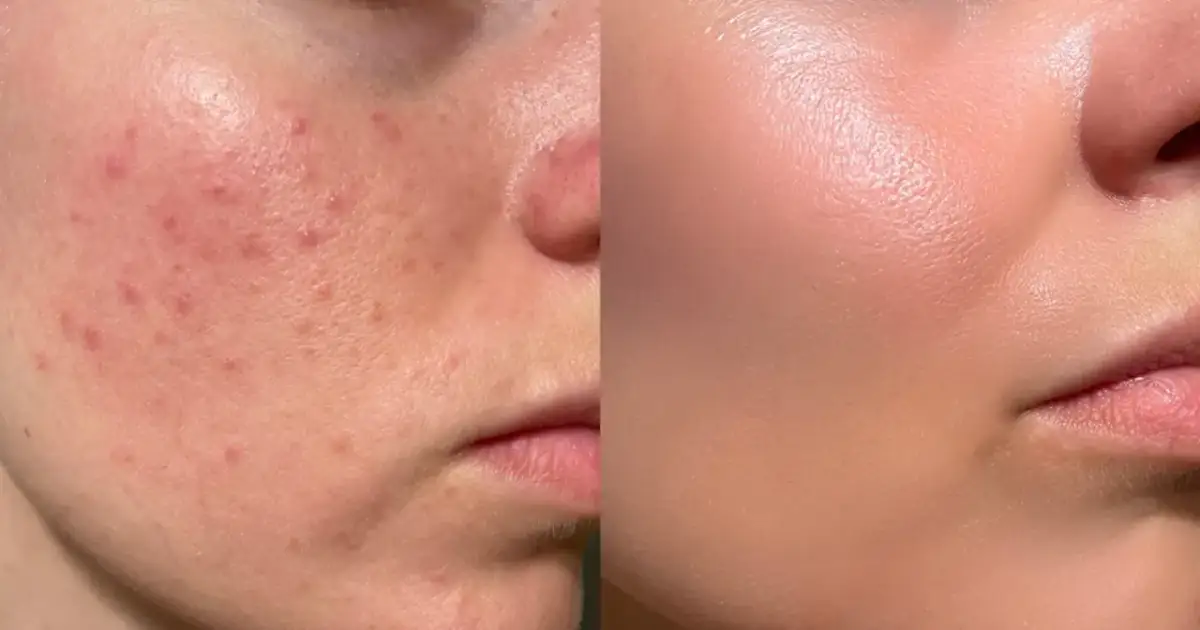 Co jeść na cerę? Dieta, która odmieni Twoją skórę!