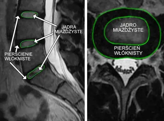 Zapalenie krążka międzykręgowego objawy: jak je rozpoznać i leczyć