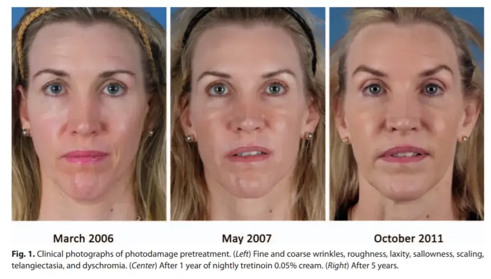 Retinol lek na co? Odkryj jego skuteczność w leczeniu skóry