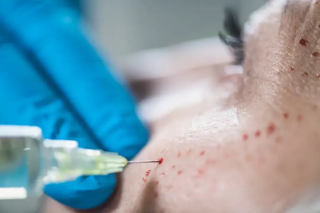 Skutki uboczne wampirzego liftingu - co musisz wiedzieć przed zabiegiem