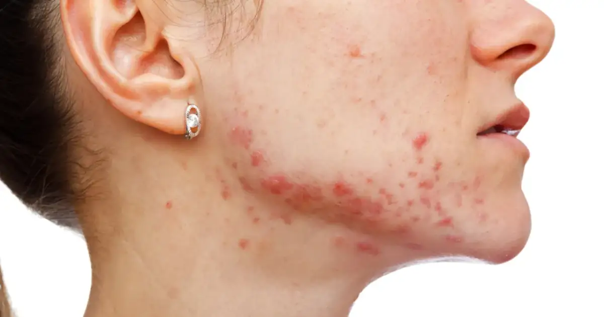 Skóra z widocznymi zmianami trądzikowymi. Szukasz informacji, co stosować na pryszcze?