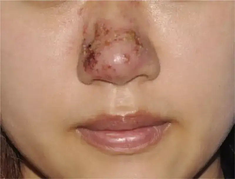 Biofilm po kwasie hialuronowym objawy: jak uniknąć powikłań?