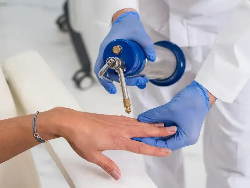 Jaki lekarz usuwa kurzajki? Sprawdź, kto pomoże w leczeniu