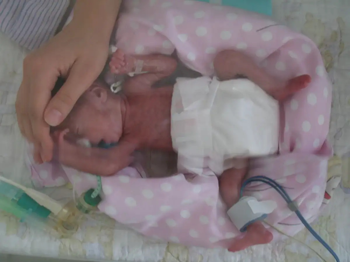 Jak wygląda dziecko urodzone w 22 tygodniu ciąży? Rozwój i szanse przeżycia wcześniaka