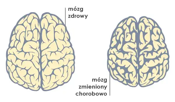 Demencja to choroba mózgu, nie psychiczna. Wyjaśniamy różnice.
