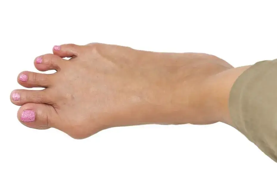 Ból haluksa: przyczyny, objawy i skuteczne sposoby na ulgę