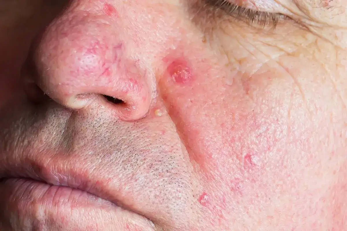 Pryszcze na nosie: Od czego są i jak się ich pozbyć?
