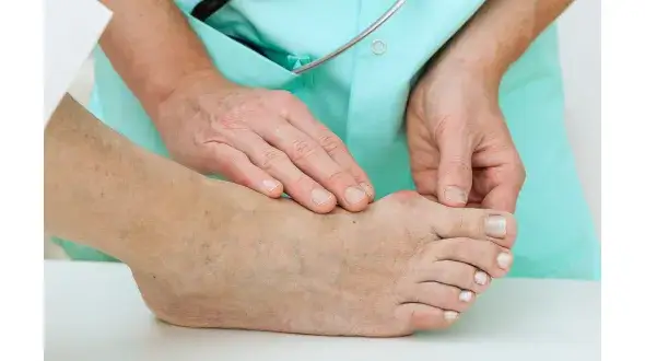 Kiedy operować haluksy? Kluczowe wskazania i najlepszy czas na zabieg