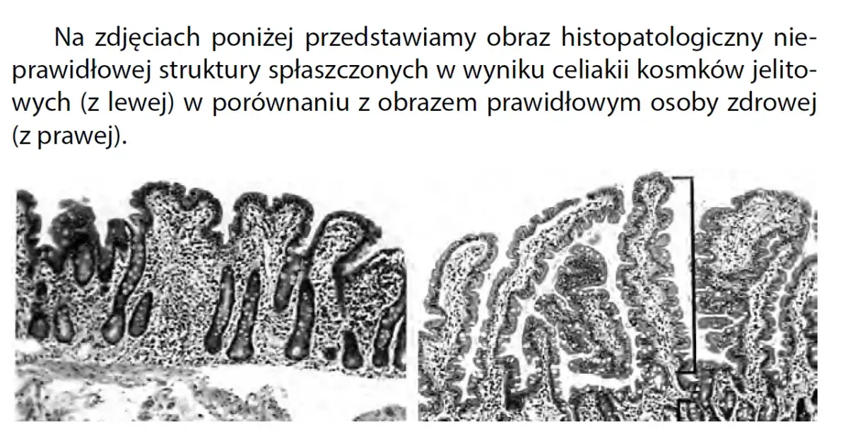 Celiakia jaki lekarz - jak nie popełnić błędu w diagnozie?
