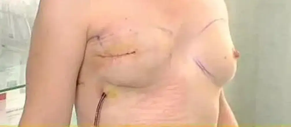 Gdzie wykonać profilaktyczną mastektomię na NFZ i uniknąć ryzyka?