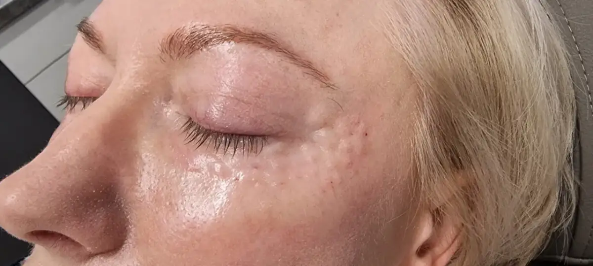 Botoks Warszawa: Jak wybrać bezpiecznie i z naturalnym efektem?