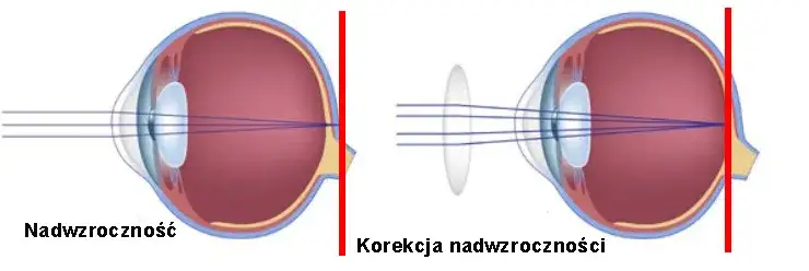 Wada wzroku jak widzi: jak różne wady wpływają na percepcję świata