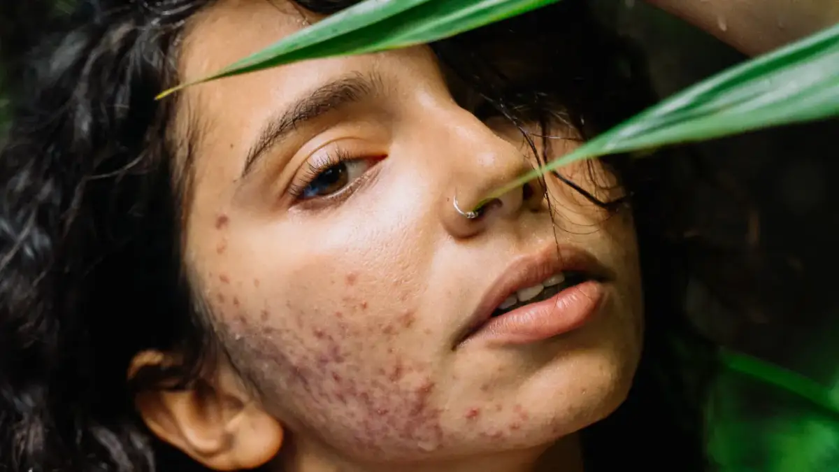 Czy pasta do zębów pomaga na pryszcze? Prawda i bezpieczne alternatywy