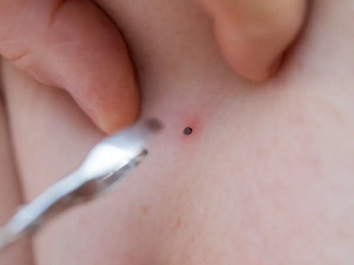 Pozostał fragment kleszcza w skórze? Co robić i czy jest się czego bać?