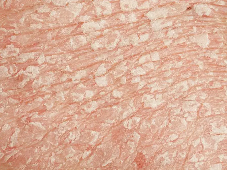 Trockene Gesichtshaut mit Schuppen: Ursachen und effektive Lösungen