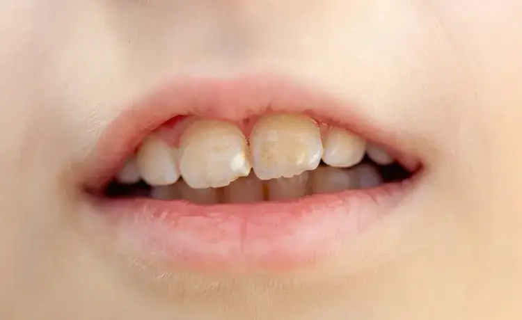 Jak wyleczyć próchnicę bez dentysty? Co możesz, a czego nie!