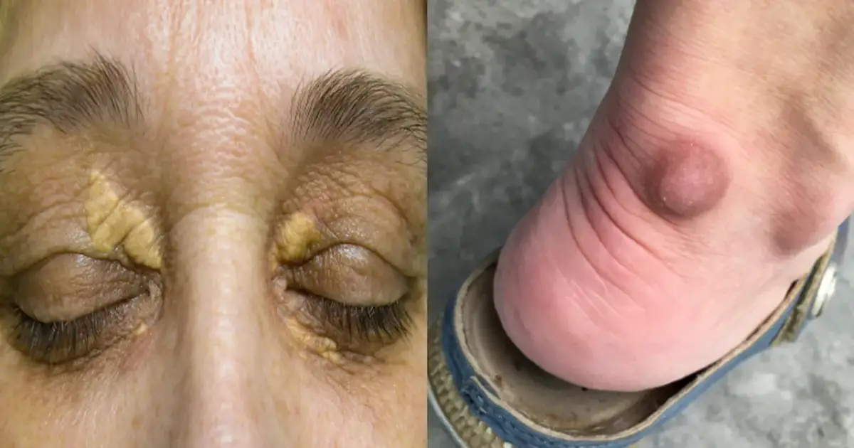 Jakie są objawy wysokiego cholesterolu i kiedy mogą być groźne?