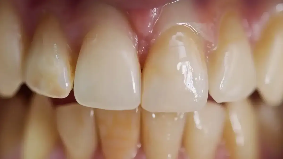 Jak usunąć przebarwienia na zębach domowe sposoby, które działają skutecznie