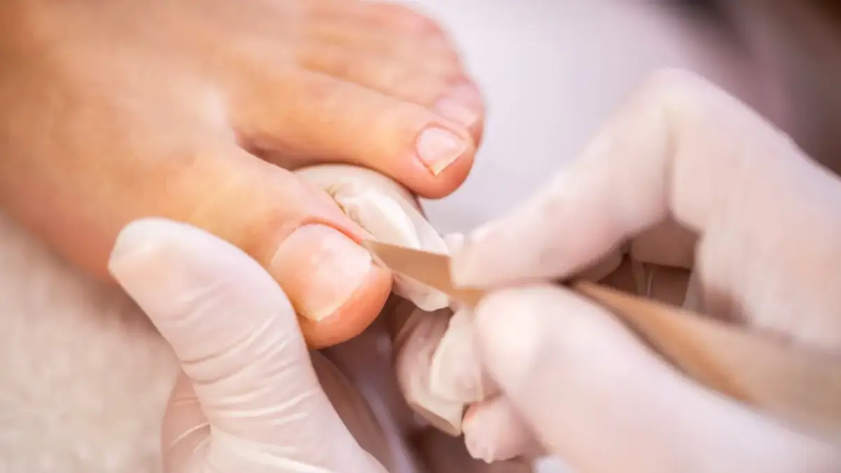 Wrastający paznokieć: ulga w domu i u specjalisty. Co naprawdę działa?