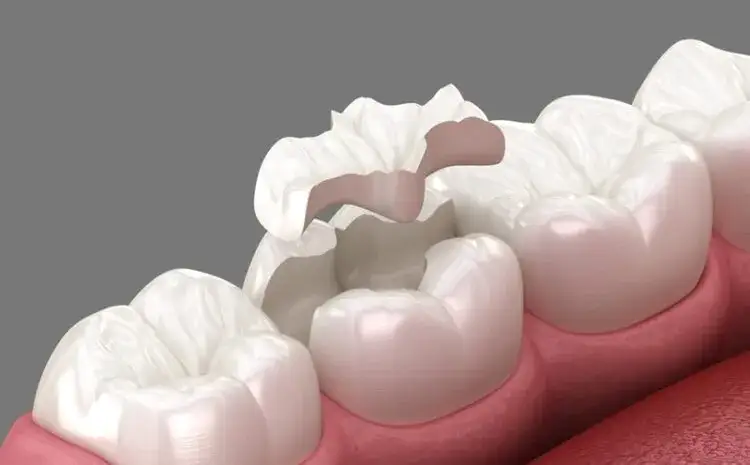 Jak odbudować zęby zniszczone amfetaminą? Pełny przewodnik