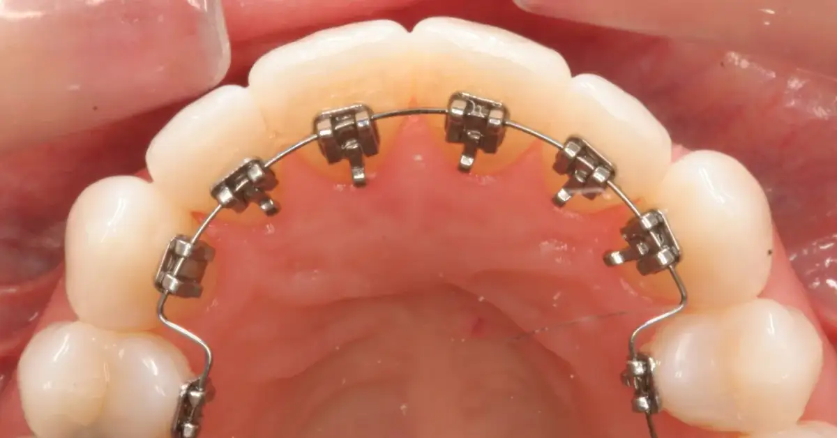 Aparat ortodontyczny: na które zęby i czy tylko na jeden łuk?