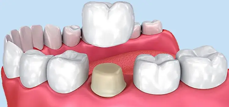 Ile kosztuje korona zęba? Poznaj wszystkie koszty i uniknij pułapek
