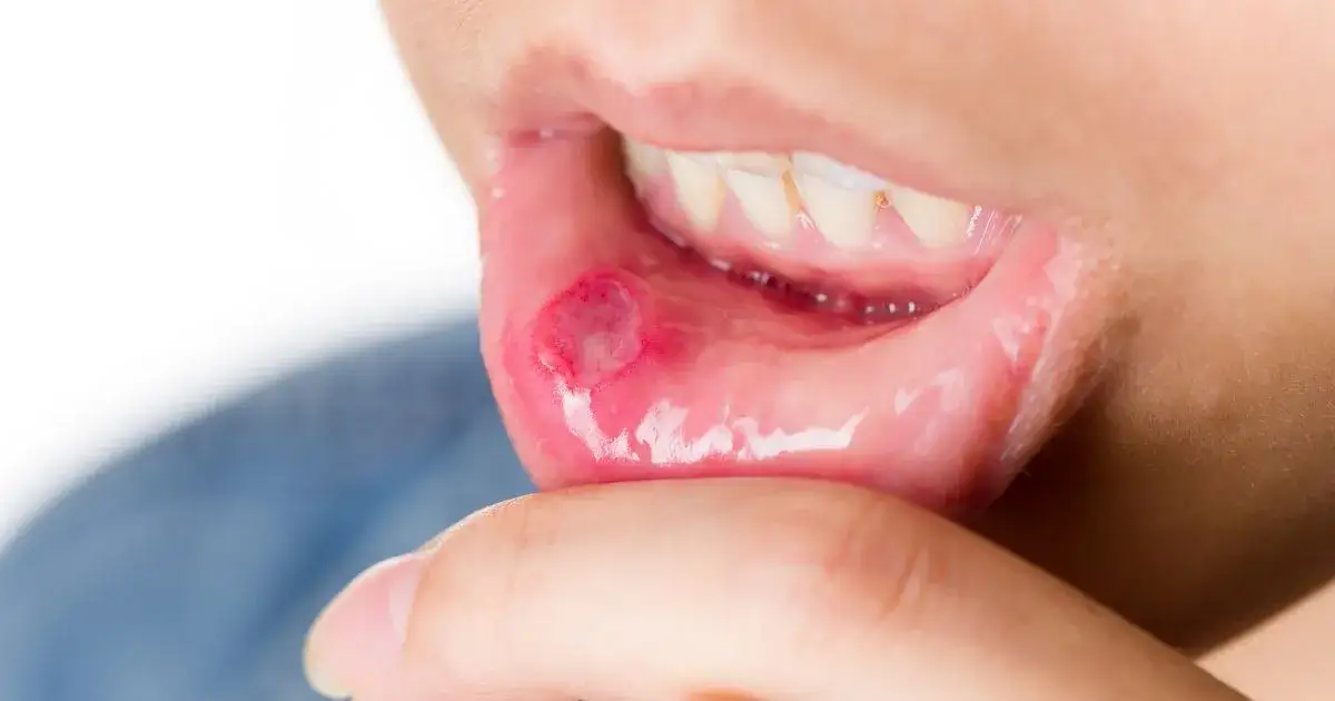 Afta a dentysta: Kiedy iść, a kiedy przełożyć wizytę?