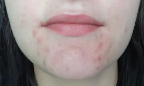 Skutki uboczne po odstawieniu Tetralysal – co musisz wiedzieć?