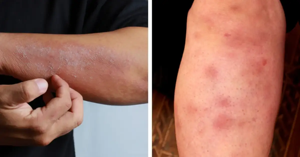 Zaburzona flora jelit: objawy, które zaskakują. Kiedy do lekarza?