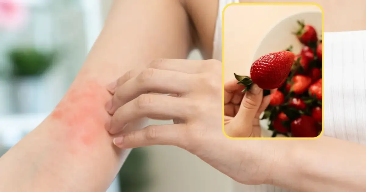 Czerwona, swędząca wysypka na ramieniu pokazuje, jak wygląda uczulenie na truskawki. Obok widać soczyste owoce.