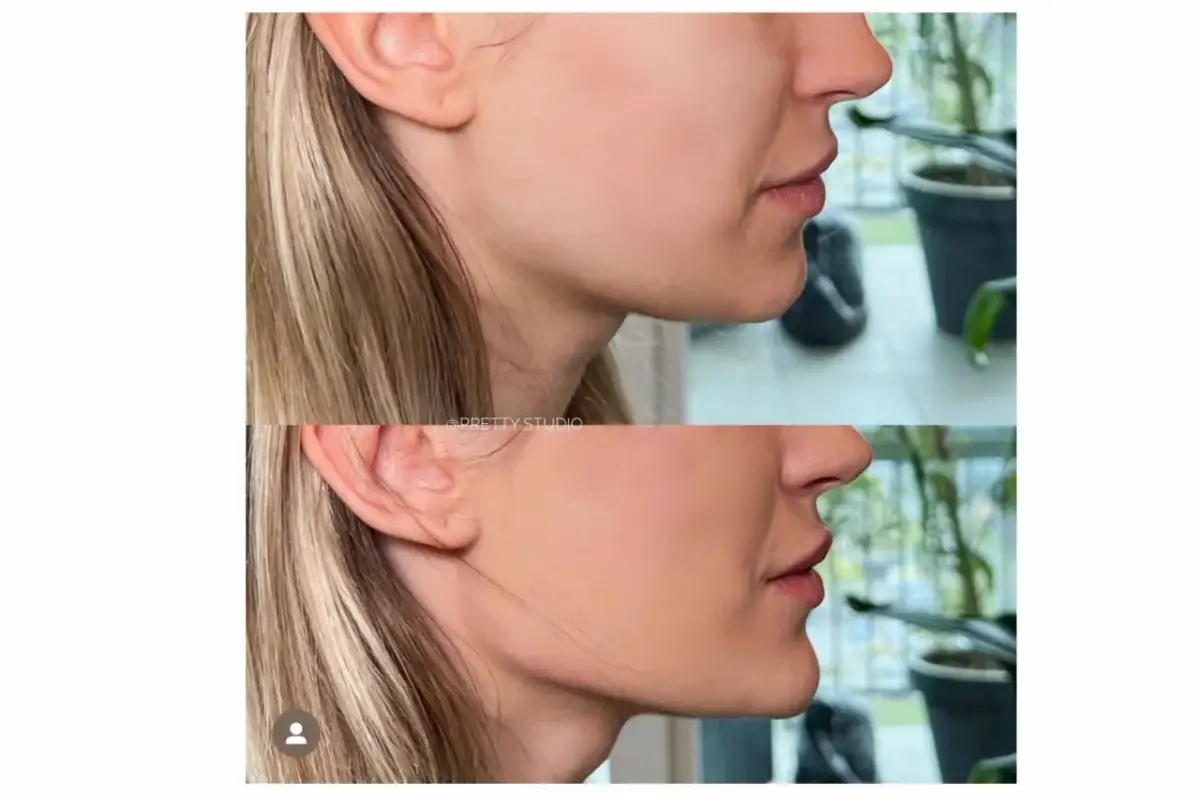 Endermologia twarzy: Lifting bez skalpela? Sprawdź efekty!